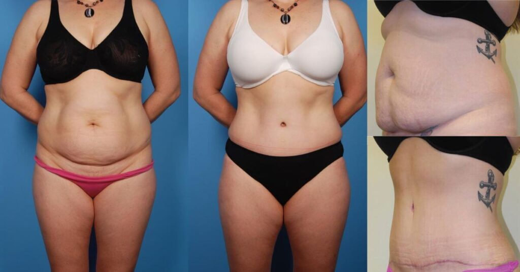 How Tummy Tuck Surgery Can Be a Game-Changer for Obesity